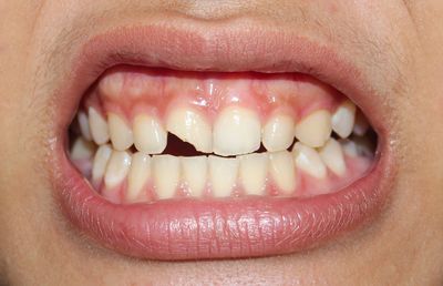 Mouth showing a chipped front tooth. The gums are pink, and the other teeth are white.