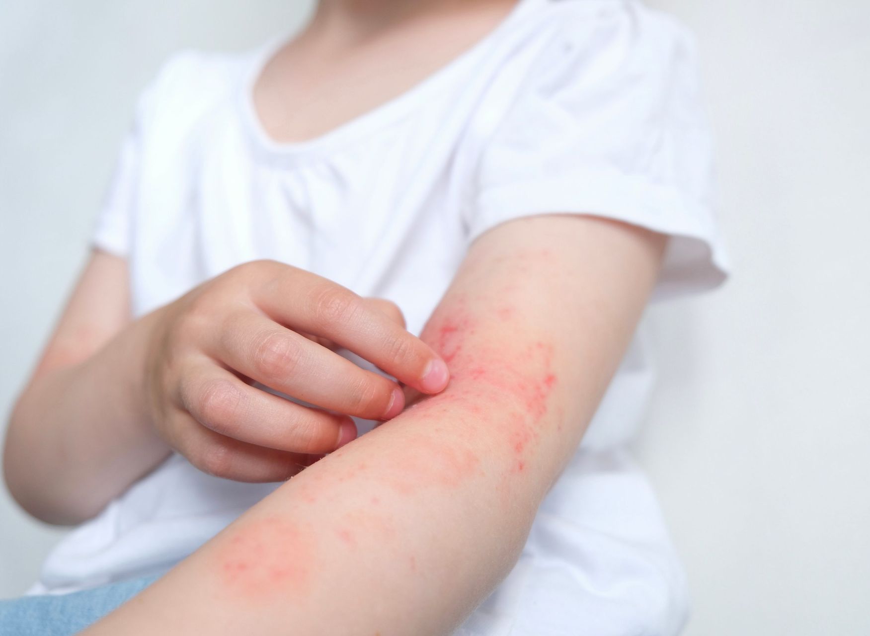 A little girl is scratching her arm with red spots.