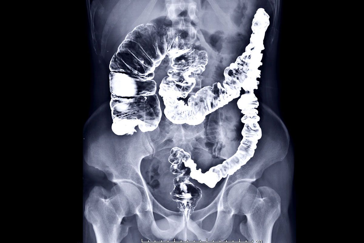 Cáncer colo rectal