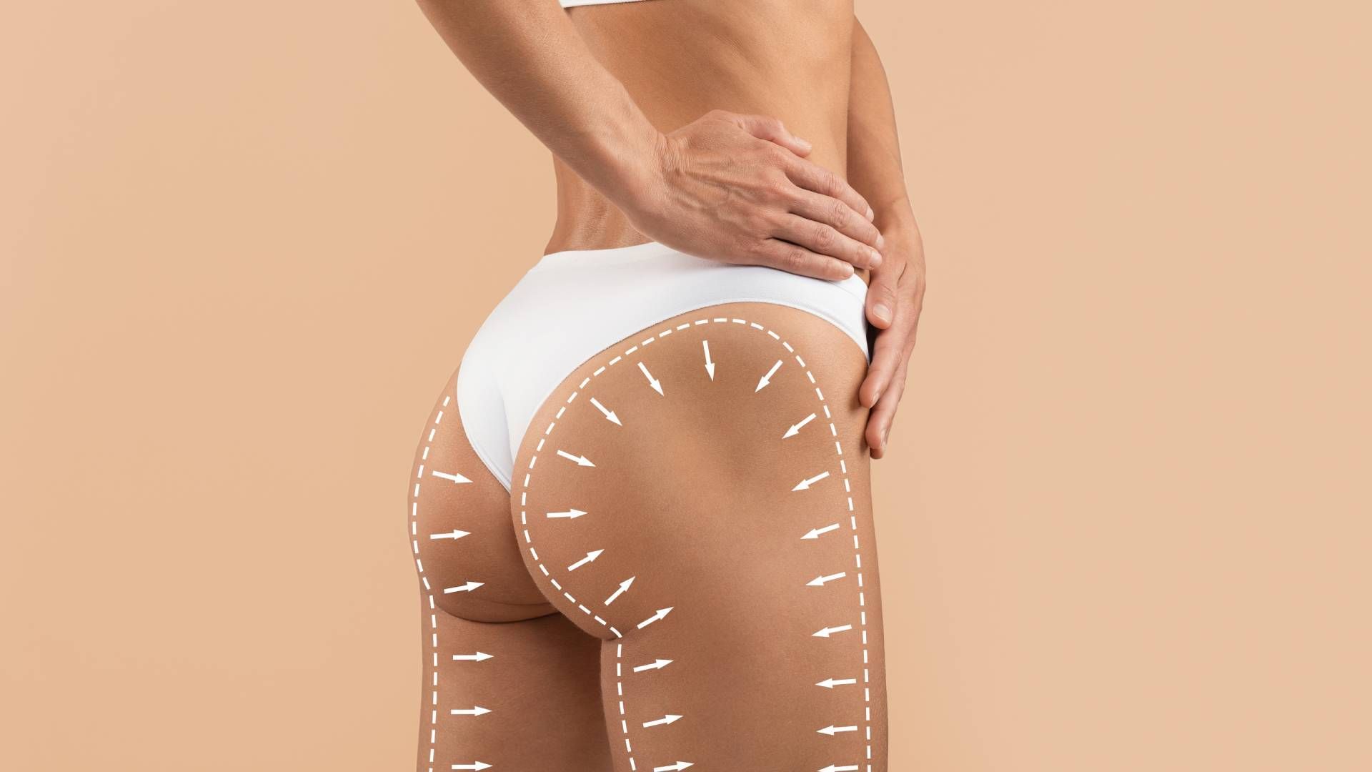 A female patient with arrows showing how cool sculpting lasts on buttocks near Lexington, Kentucky (