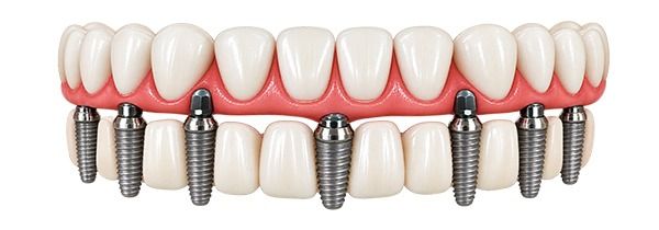 All-on-4 Dental Implants