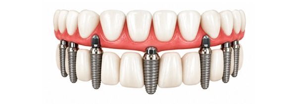 All-on-6 Dental Implants