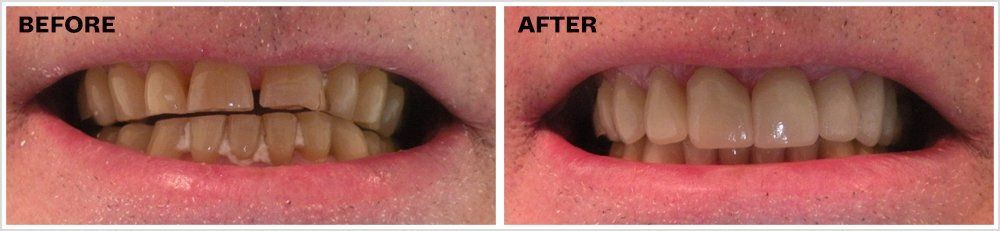 Full mouth restoration with crowns