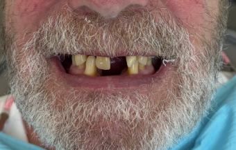 All-on-6 Transformation