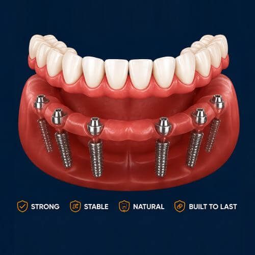 Dental Implant