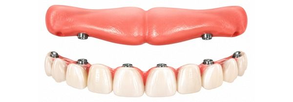 Snap-On Dentures