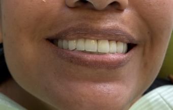 Zirconia Crowns