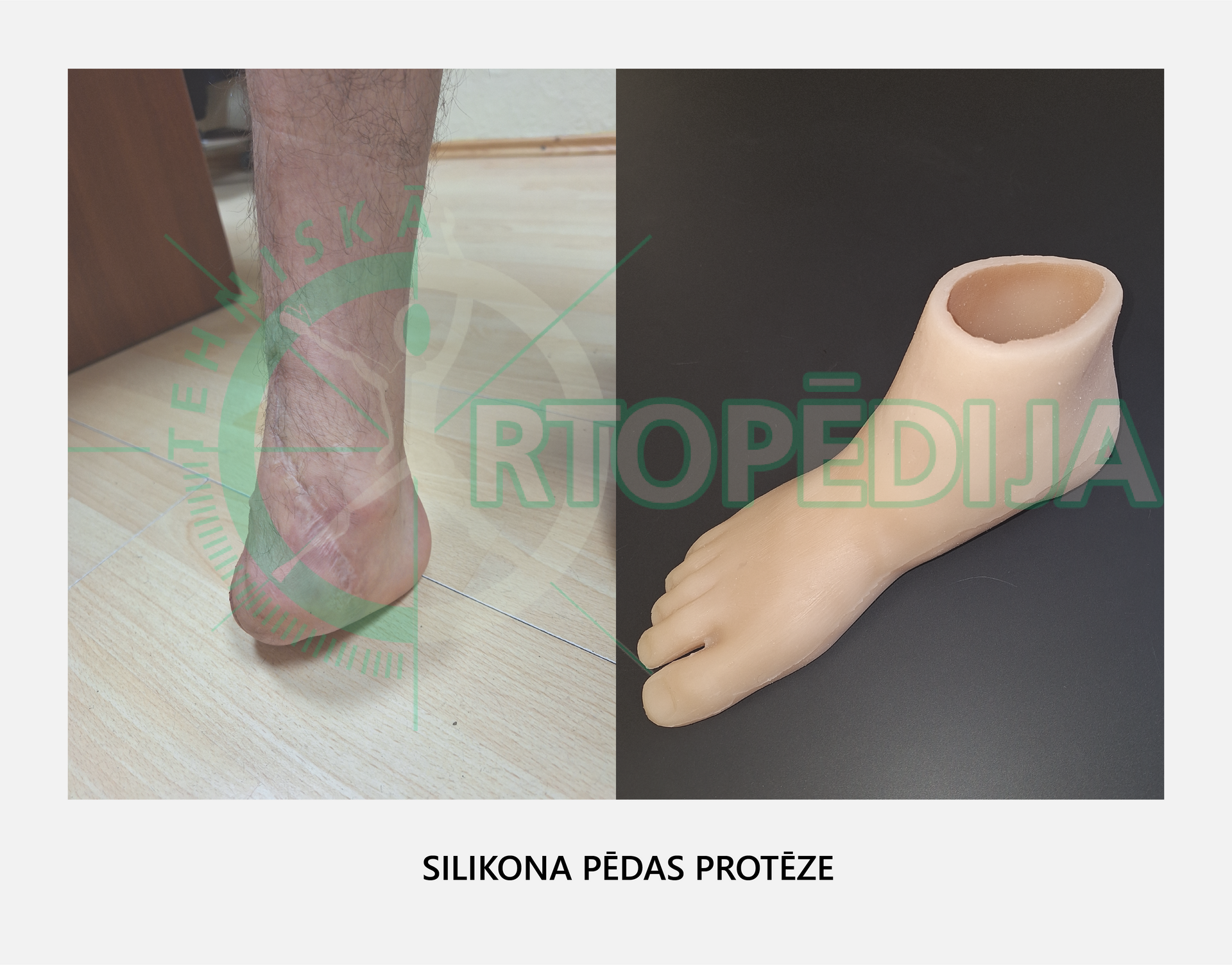 Silikona pēdas protēze