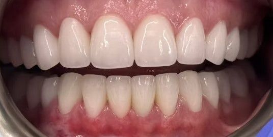 A close up of a person 's teeth with white teeth.