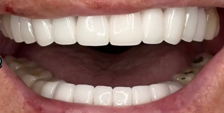 A close up of a person 's mouth with white teeth.