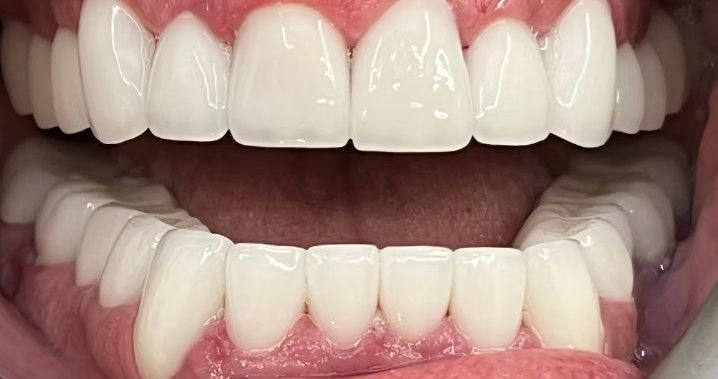 A close up of a person 's teeth with white teeth.