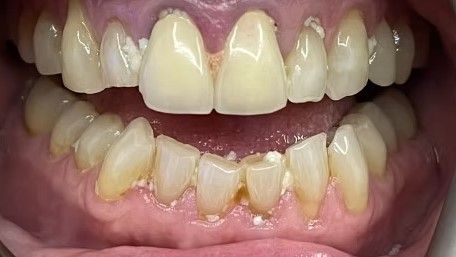 A close up of a person 's teeth with a lot of stains on them.