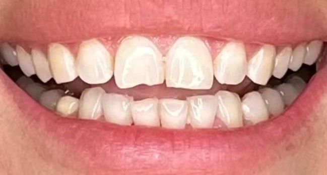 A close up of a person 's teeth with a missing tooth.