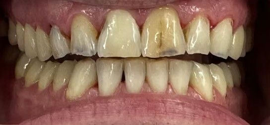 A close up of a person 's teeth with a broken tooth.