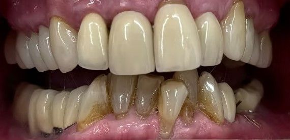 A close up of a person 's teeth with a lot of plaque on them.