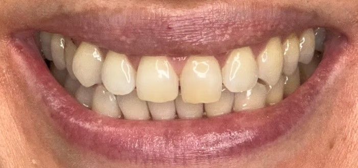 A close up of a woman 's smile with white teeth.