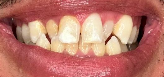 A close up of a man 's teeth with a beard.