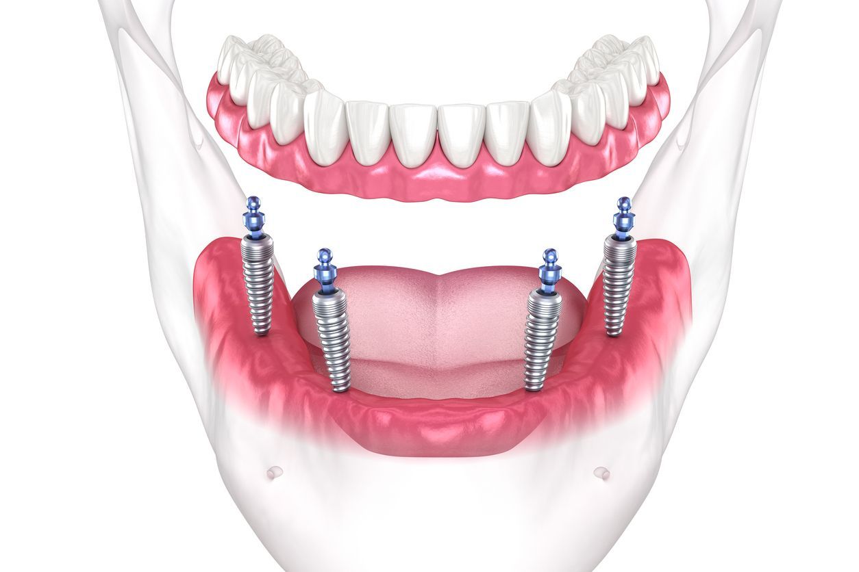 A computer generated image of a person 's mouth with dental implants.