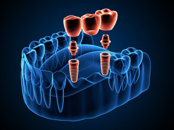 X-ray view of dental implants and bridge in the lower jaw.