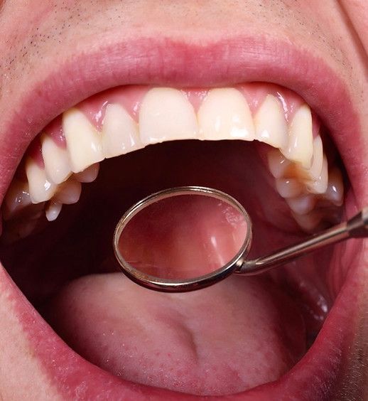 A man is getting his teeth examined with a dental mirror