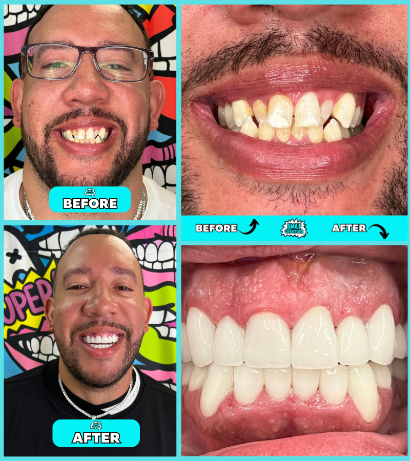 A before and after photo of a man 's teeth