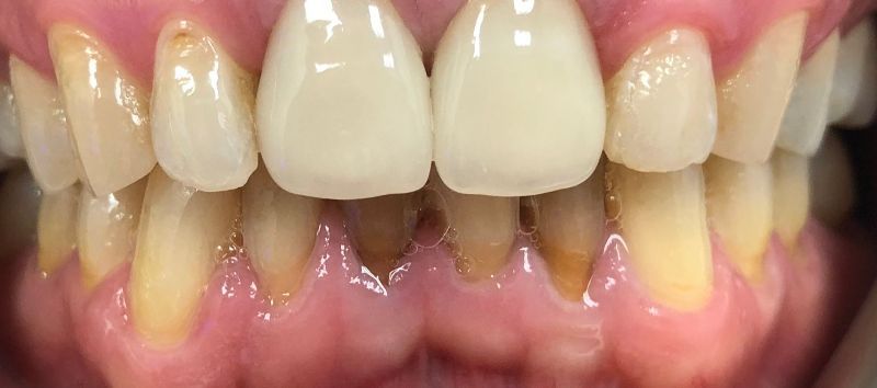 A close up of a person 's teeth with white teeth and yellow teeth.
