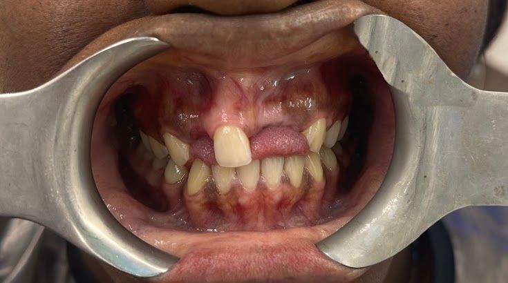 A close up of a person 's mouth with a metal device in it.