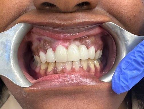 A close up of a person 's teeth with a mouth guard.