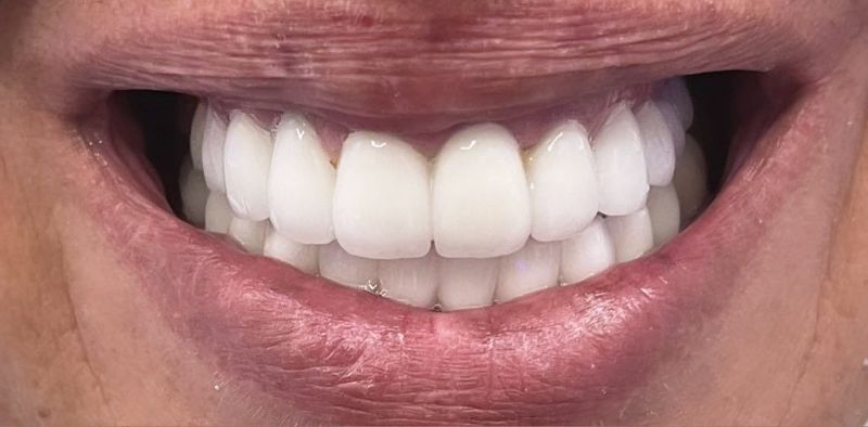 A close up of a person 's smile with white teeth.