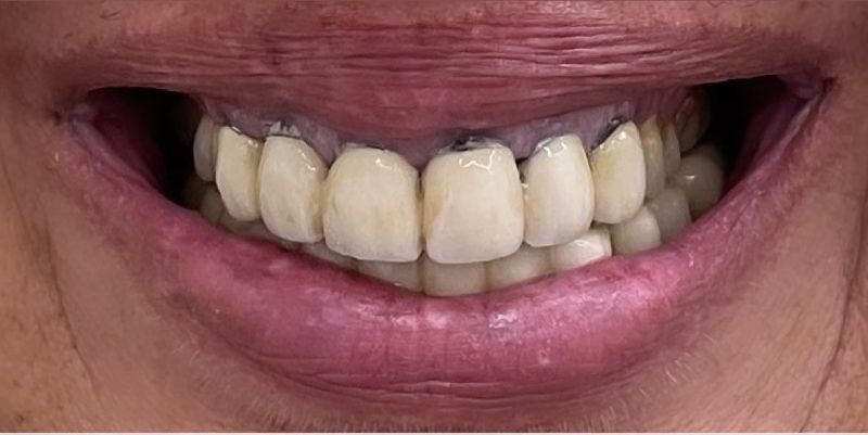 A close up of a person 's mouth with a lot of teeth.