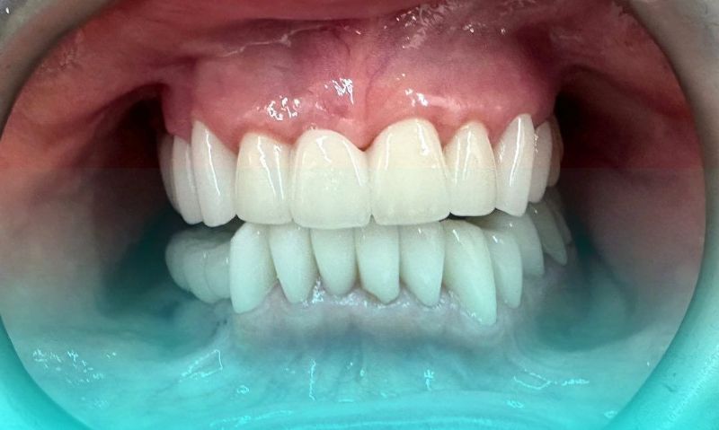 A close up of a person 's teeth in a mouth guard.