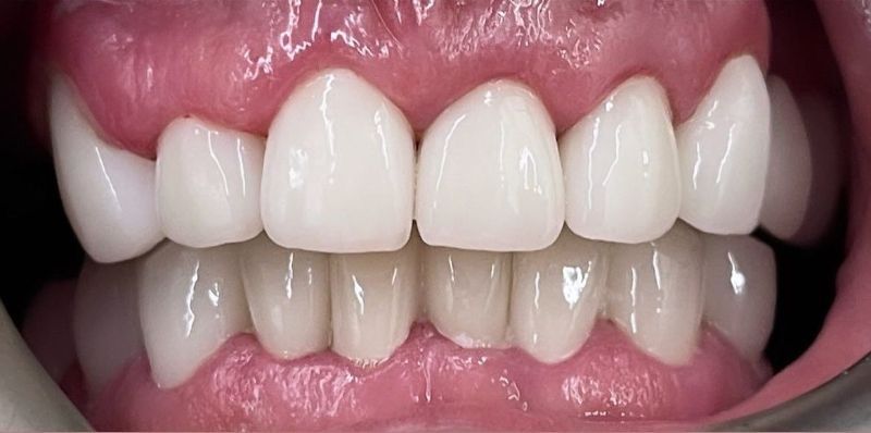A close up of a person 's teeth with white teeth.