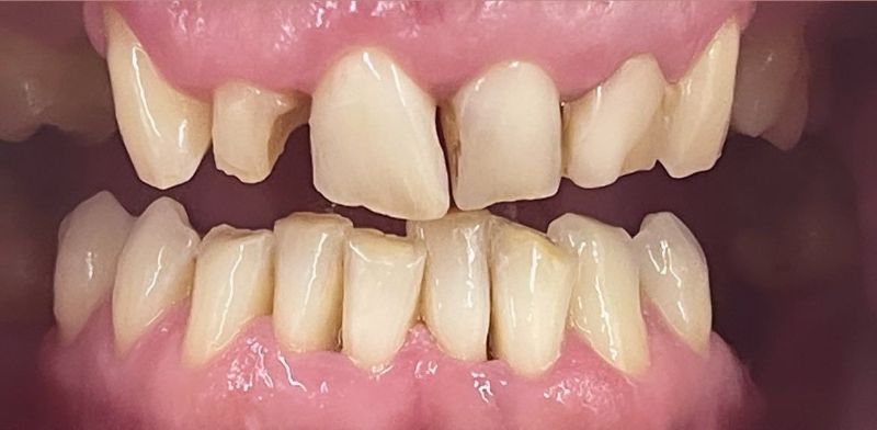 A close up of a person 's teeth with a broken tooth.