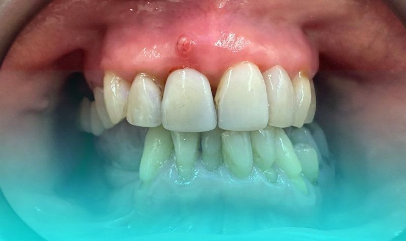 A close up of a person 's teeth and gums.