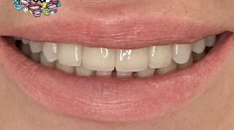 A close up of a woman 's smile with white teeth.