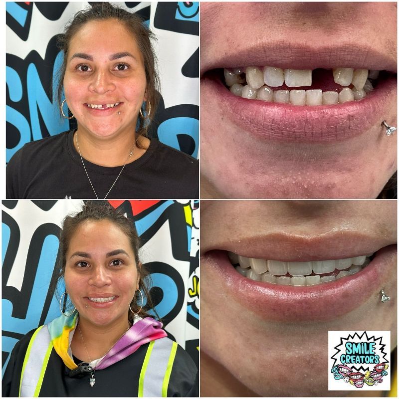 A woman 's face is shown before and after a smile creations treatment