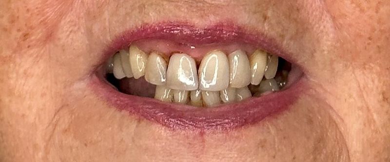 A close up of an elderly woman 's teeth and lips.