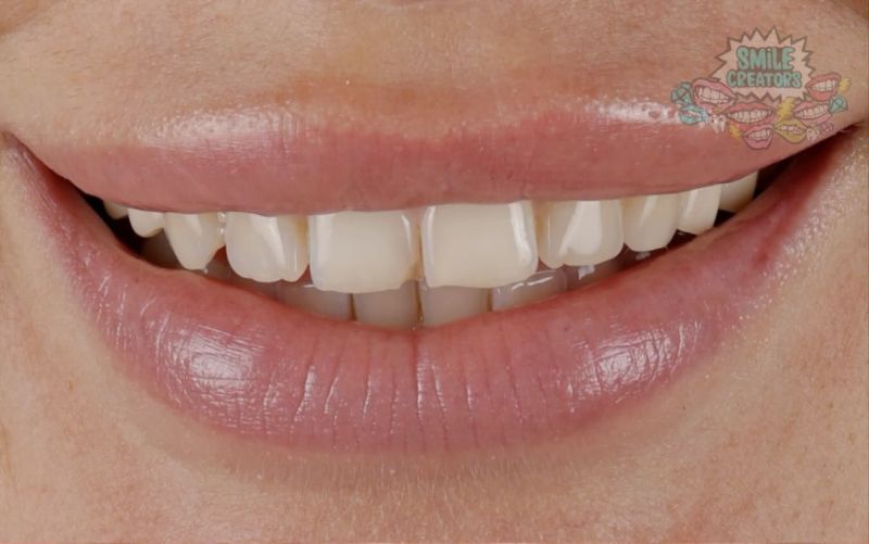 A close up of a woman 's smile with white teeth.