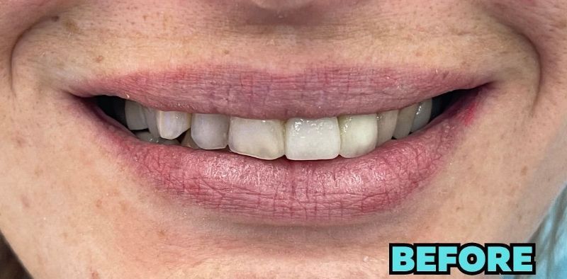 A close up of a woman 's mouth with white teeth.