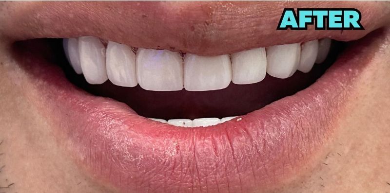 A close up of a person 's mouth with white teeth.