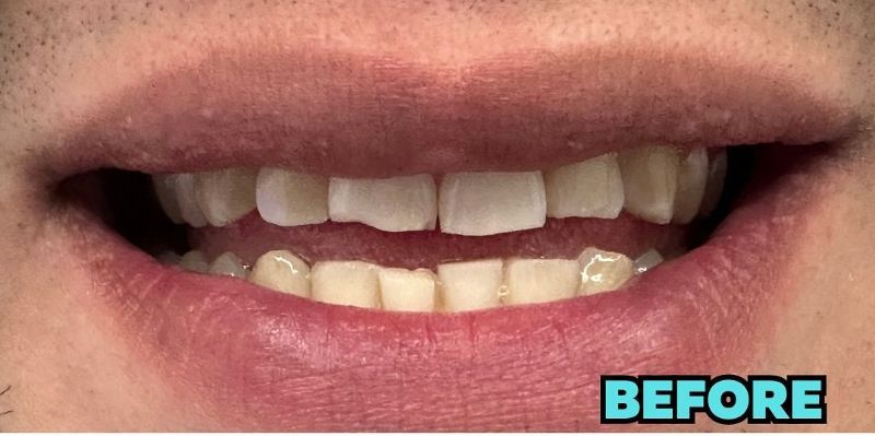 A close up of a man 's mouth with a broken tooth.