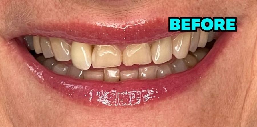 A close up of a woman 's teeth before a dental treatment.