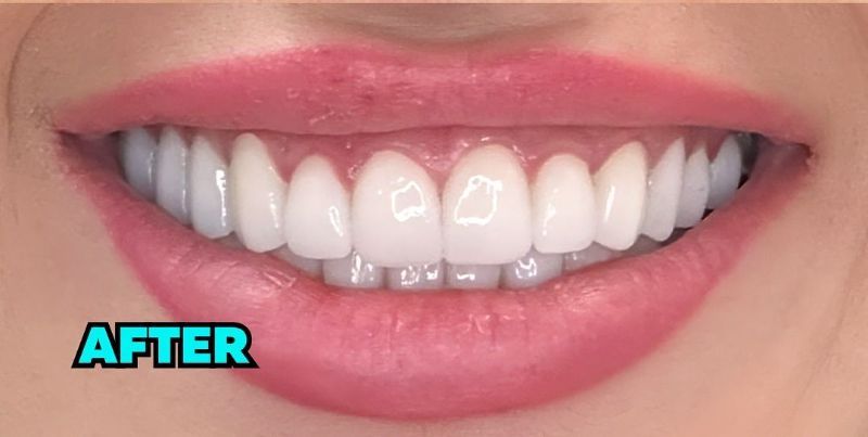 A close up of a woman 's teeth with the words after below it.