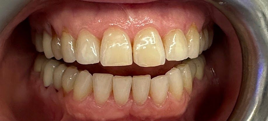 A close up of a person 's teeth with white teeth.