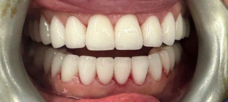 A close up of a person 's teeth with white teeth.
