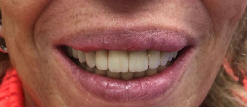 A close up of a woman 's smile with white teeth and pink lips.