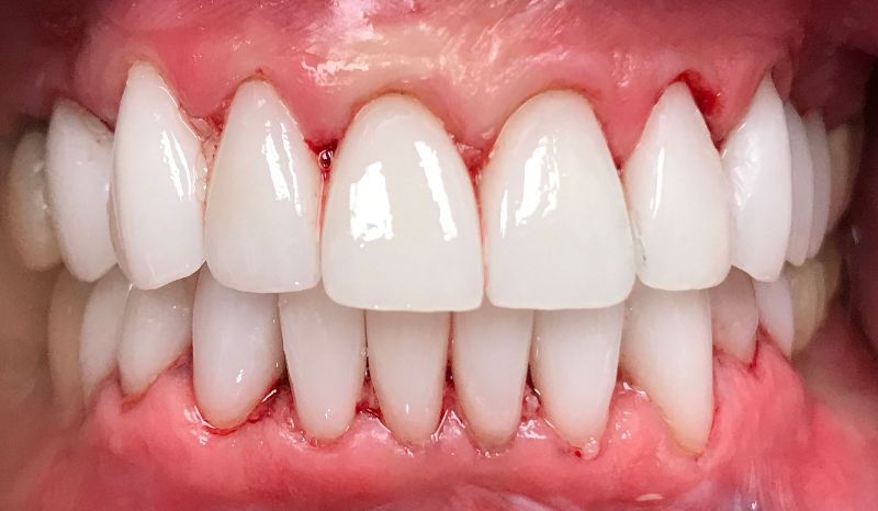 A close up of a person 's teeth with red gums.