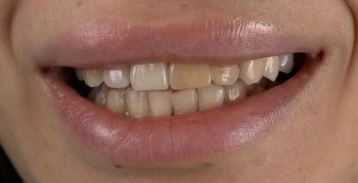A close up of a person 's mouth with white teeth.
