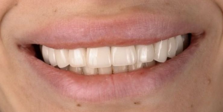 A close up of a person 's smile with white teeth.