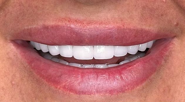 A close up of a woman 's smile with white teeth.